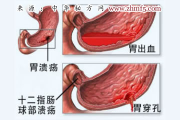 用气功法治胃溃疡有奇效