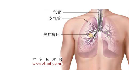 治肺癌的偏方