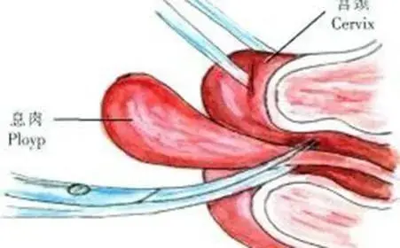 导致宫颈息肉的原因有哪些 引起宫颈息肉的六个原因