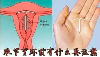 女性取环后多久可以同房 女人取环后的注意事项