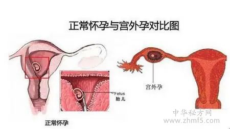 女性宫外孕打掉的最佳时间