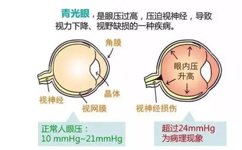 青光眼到瞎一般得多久 青光眼失明是迟早的吗