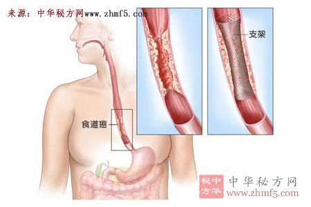 食管癌