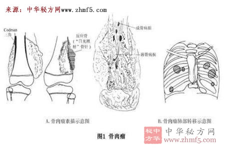 骨肉瘤