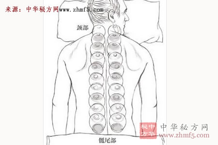 抑郁、烦闷别着急，试试用火罐拔走！