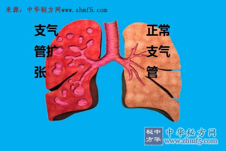 支气管扩张