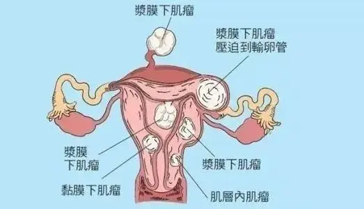 哪些女性容易得子宫肌瘤 这8种人群要注意预防子宫肌瘤