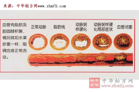 动脉粥样硬化