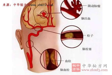 脑血管疾病怎么调养、调理方法、饮食指南、治疗方法