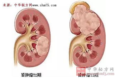 肾炎