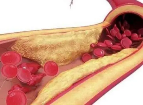 血脂高怎么降下来 牢记这三点或许对你有帮助