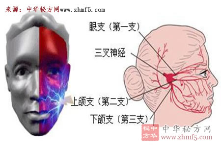 三叉神经痛